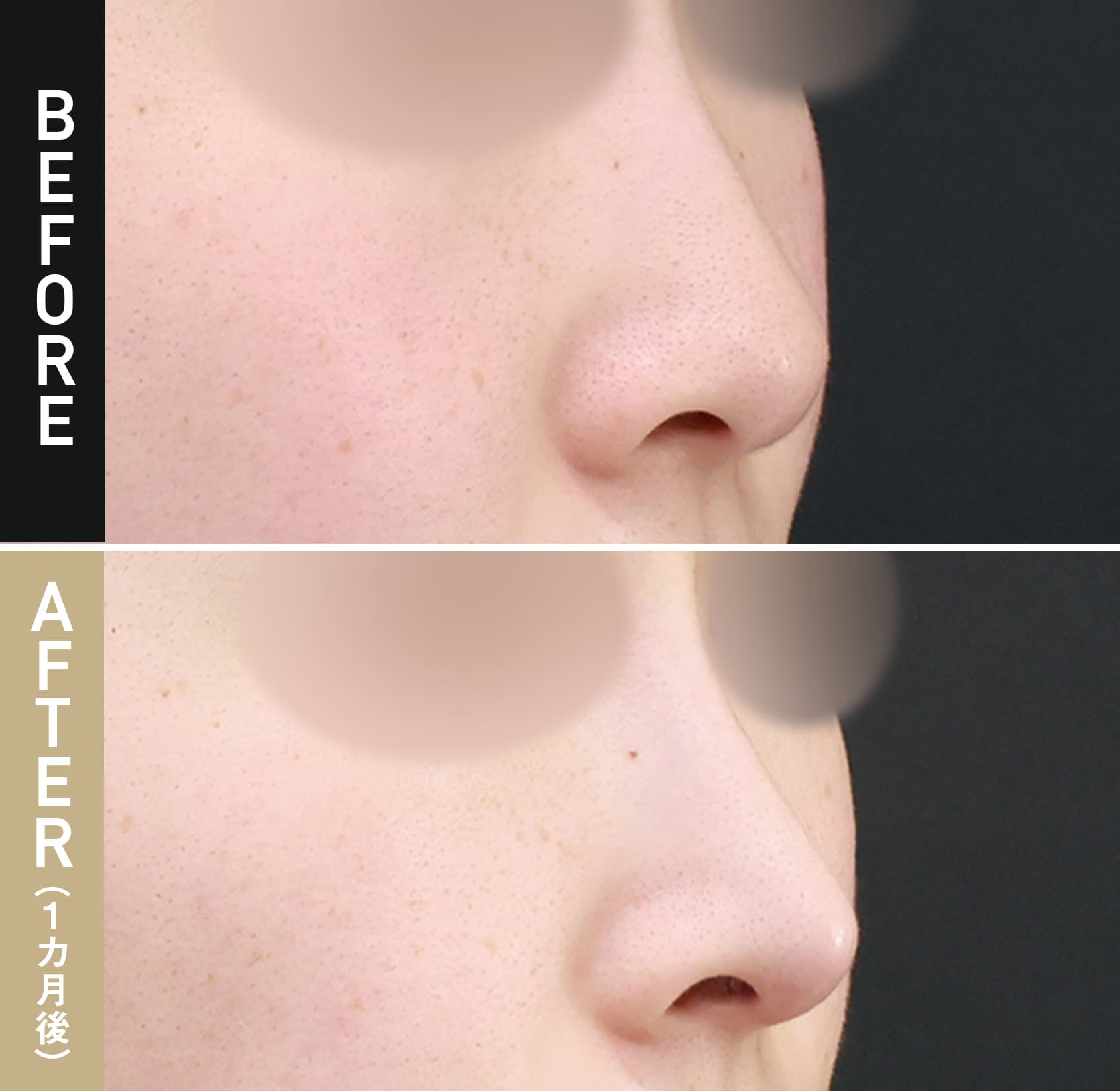 鼻尖形成（鼻尖縮小）|症例写真（術後1カ月）|30代女性