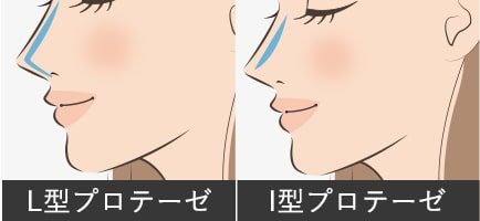 隆鼻術プロテーゼイメージ