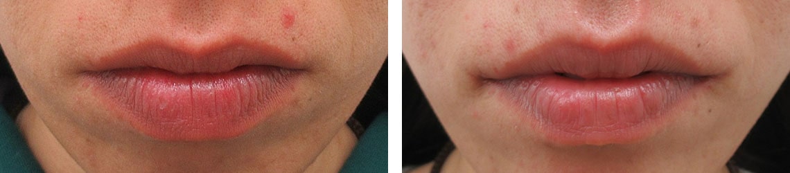 口整形 唇整形 高崎taクリニック 高崎駅のおすすめ美容外科 唇ヒアルロン酸 口角リフト 安い費用で