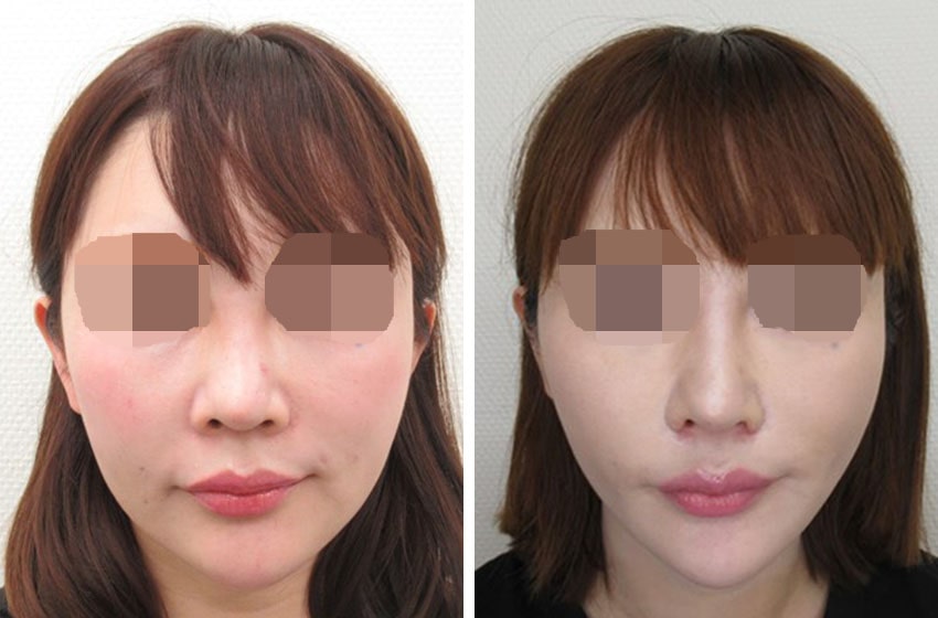 顔の脂肪除去一覧 頬 口角 口元 輪郭 たるみ バッカルファット除去 マリオネットライン ジョールファット除去 高崎taクリニックアソシエ