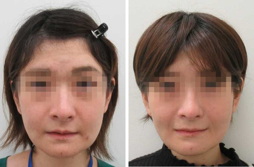顔の脂肪除去一覧 頬 口角 口元 輪郭 たるみ バッカルファット除去 マリオネットライン ジョールファット除去 高崎taクリニックアソシエ