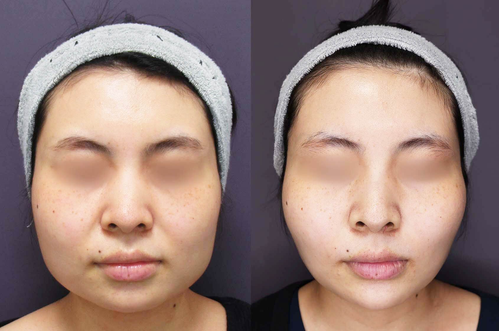 ボトックス注射 ボツリヌストキシン エラ 口角 ふくらはぎ 肩 目の下 脇汗に 効果と料金 群馬県高崎市の美容整形外科 高崎taクリニック高崎taクリニック 群馬 高崎の美容整形 美容外科